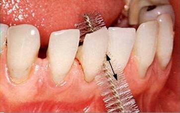 Ο καθαρισμός μεταξύ των δοντιών χρησιμοποιώντας μεσοδόντιο βουρτσάκι